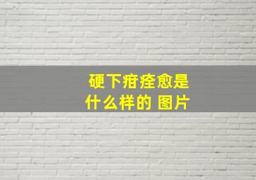 硬下疳痊愈是什么样的 图片